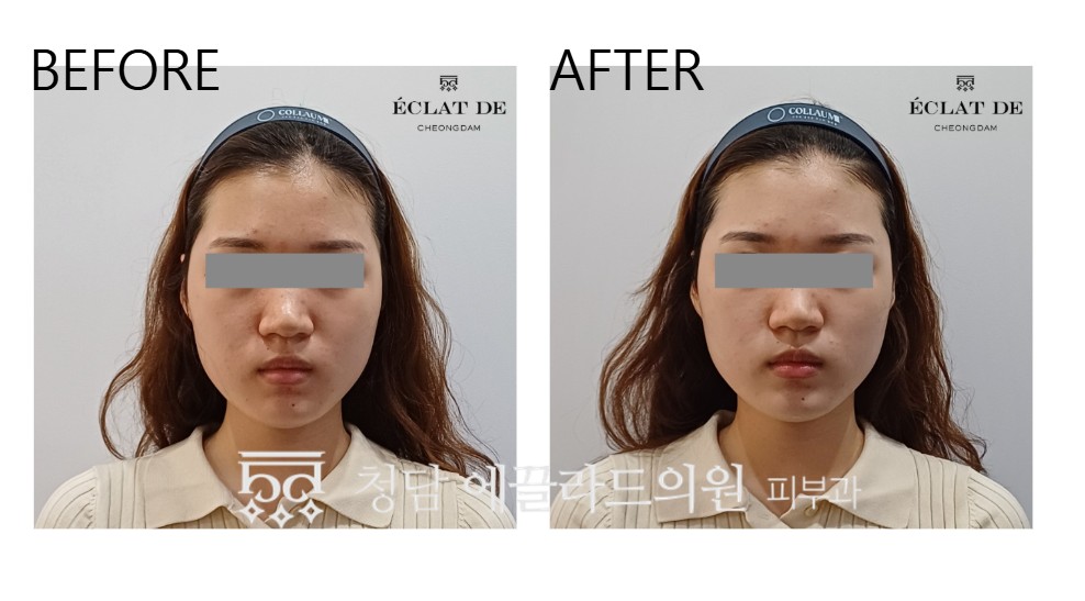 Accu Toning – ビフォー&アフター（エクラ・デ）